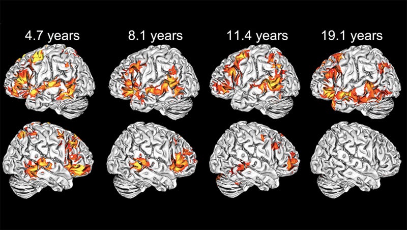 Illustration of eight brains showing how left-hemisphere language areas is evident in the youngest children declines over age from 4.7 years to 8.1 years to 11.4 years to 19.1 years of age